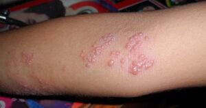 Vacinação contra herpes-zóster é fundamental para prevenir a doença na terceira idade